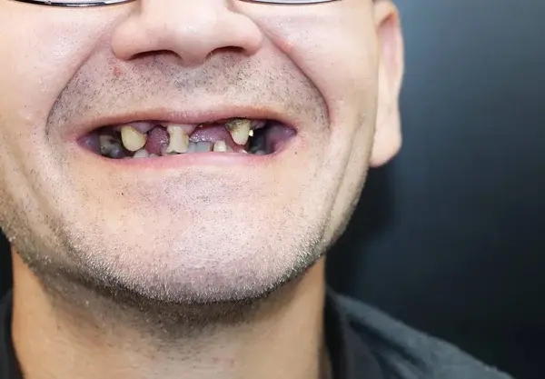 depositphotos292461441-stock-photo-man-has-rotten-teeth-teeth